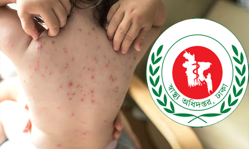 হাম ও উপসর্গে আরো ৫ শিশুর মৃত্যু 